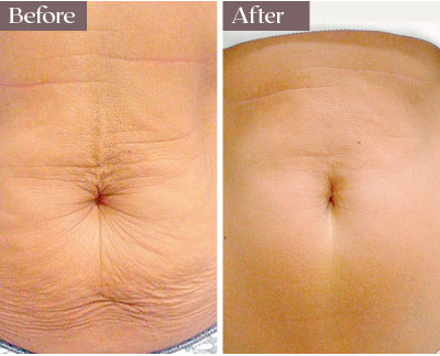 thermage before after nyc